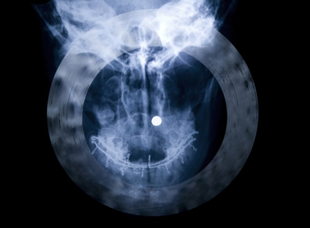 Original hospital x-rays of my head and jaw